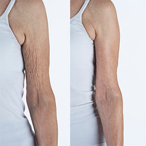 What are ‘Old Lady Arms’ & How to Get Rid of Them